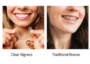 Invisible braces Vs. Traditional Braces - which one is best