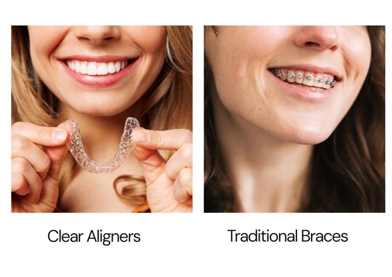 Invisible braces Vs. Traditional Braces - which one is best